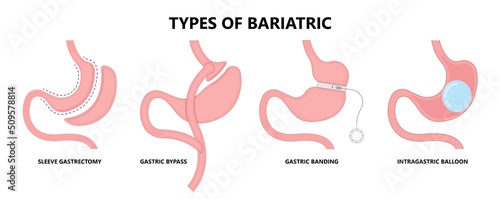 Gastric bypass surgery and Band roux en y procedure endoscopy weight loss hiatal hernia diet food full body mass index or BMI reflux GERD eat obese clinic tummy tuck small lap sleep apnea high blood