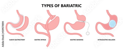 Gastric bypass surgery and Band roux en y procedure endoscopy weight loss hiatal hernia diet food full body mass index or BMI reflux GERD eat obese clinic tummy tuck small lap sleep apnea high blood photo