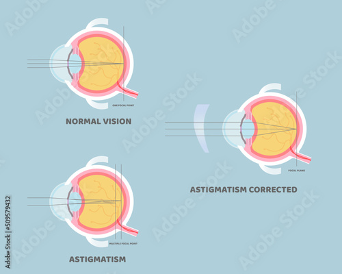 eyeball anatomy, internal organs body part nervous system, astigmatism corrected, eyesight concept, vector illustration cartoon flat design clip art