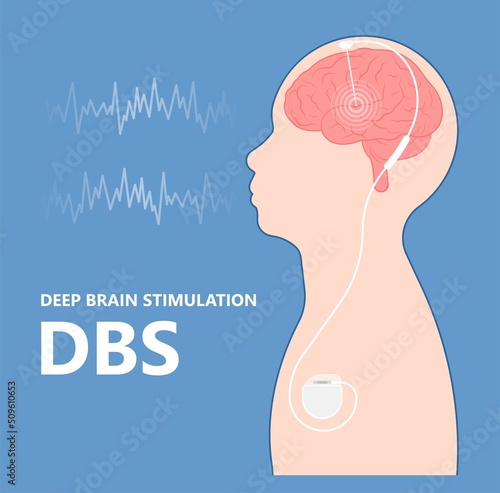 Deep brain stimulation or DBS treat Parkinson's disease PD and TMS condition major neural stimulator pulse neurological wave implanted Motor bipolar