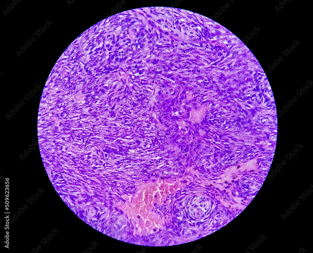 Photomicrograph of a schwannoma, a benign soft tissue tumor of peripheral nerve sheath. Photomicrograph of a schwannoma, a benign soft tissue tumor of peripheral nerve sheath.