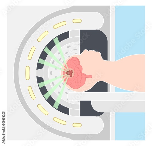 Gamma tumor cancer treat exam body X-ray MRI imaging scan medicine focus disease accelerator central nervous system beam CT Linac linear particle oncology Knife minimally invasive