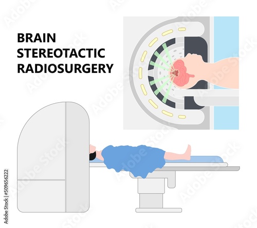Gamma tumor cancer treat exam body X-ray MRI imaging scan medicine focus disease accelerator central nervous system beam CT Linac linear particle oncology Knife minimally invasive