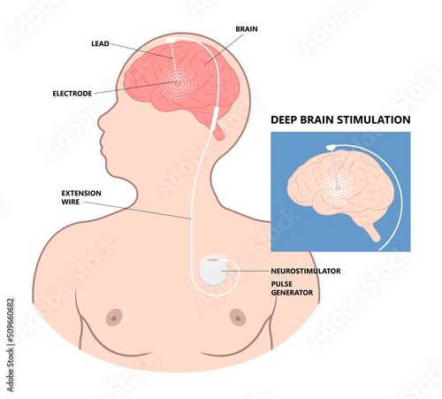 Deep brain stimulation or DBS treat Parkinson's disease PD and TMS condition major neural stimulator pulse neurological wave implanted Motor bipolar