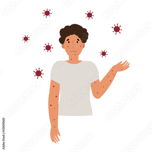 Flat vector illustration of man in t-shirt with blisters on skin caused by ingestion of monkeypox virus isolated on white background