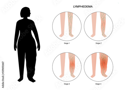 Stages of lymphedema