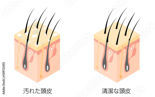 汚れた頭皮と清潔な頭皮の断面図の図解イラスト、アイソメトリック photo