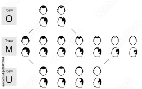AGA　男性型脱毛症の各タイプと進行ステージのイラスト