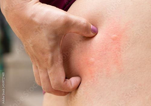 Принти на полотні Hand scratching on the itchy skin with a blister