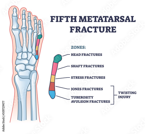 Fifth metatarsal or foot little finger fracture after injury outline diagram. Labeled educational scheme with feet trauma after twisting motion vector illustration. Anatomical skeletal bone zones.
