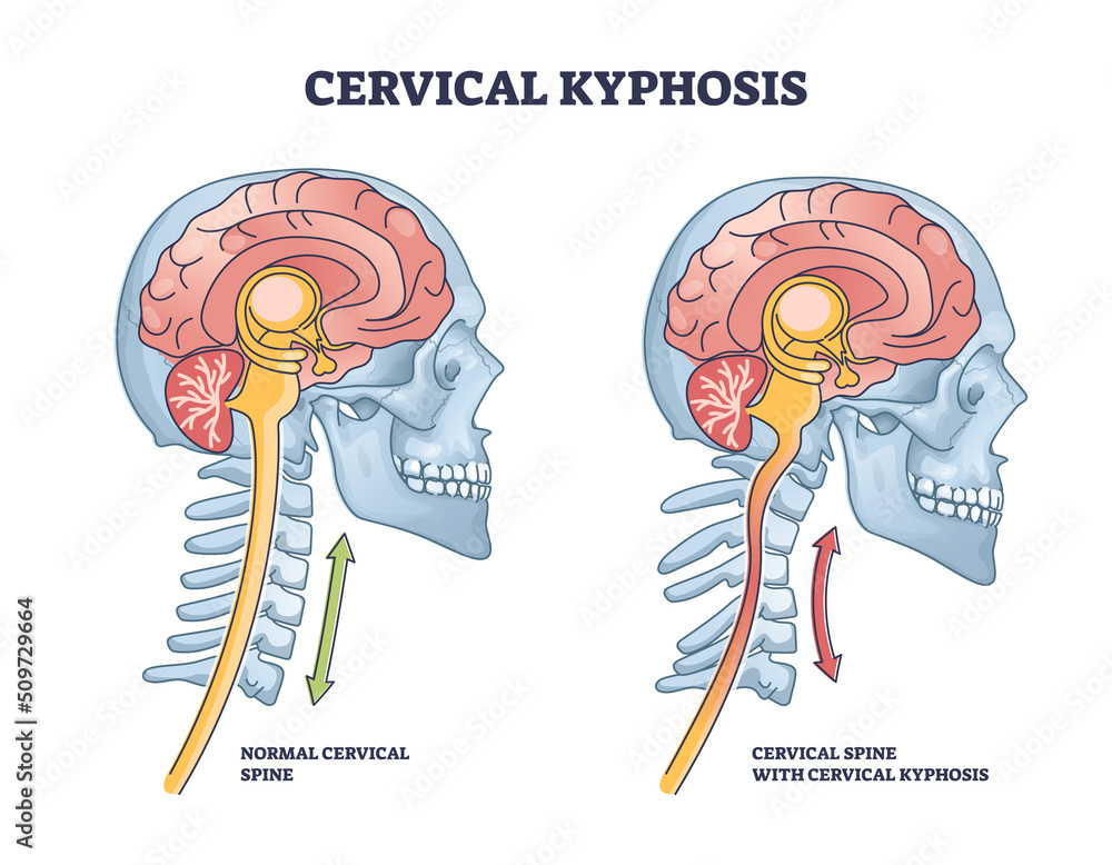 Cervical kyphosis condition with spine and neck curvature outline diagram. Labeled educational military neck syndrome compared to healthy posture vector illustration. Human body deformity anatomy. - obrazy, fototapety, plakaty 