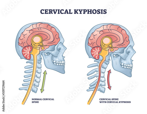 Cervical kyphosis condition with spine and neck curvature outline diagram. Labeled educational military neck syndrome compared to healthy posture vector illustration. Human body deformity anatomy.