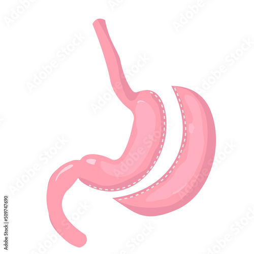 Gastric sleeve stomach. Methods of bariatric surgery. Human anatomy illustration for infographics, atlas, textbook or study material.