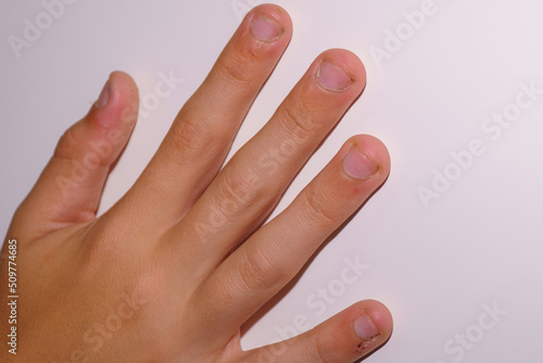 medical problem of biting fingernails photo