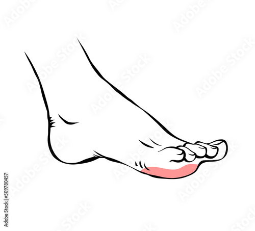 A woman leg with a sore callus. Transverse flat feet. Orthopedic disease. Female foot health problems. Vector illustration isolated on white background. Outline hand drawn style