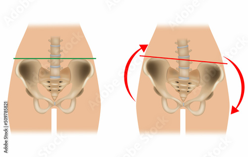Comparison of pelvic distortion. Normal pelvis and distorted pelvis. A Twisted Pelvis, also called Pelvic Torsion photo
