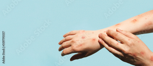 Foto Monkeypox new disease dangerous over the world