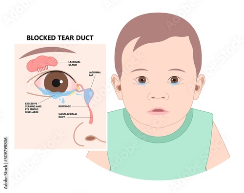 Blocked tear duct eye sinus toddler red dry swollen nasal nose pain eyelid Gland medial system drain sac birth baby child obstruct tumor polyps pink Mucus Eyedrop glaucoma Dacryolith disease
