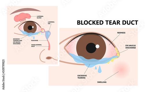 Blocked tear duct eye sinus toddler red dry swollen nasal nose pain eyelid Gland medial system drain sac birth baby child obstruct tumor polyps pink Mucus Eyedrop glaucoma Dacryolith disease