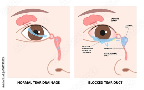 Blocked tear duct eye sinus toddler red dry swollen nasal nose pain eyelid Gland medial system drain sac birth baby child obstruct tumor polyps pink Mucus Eyedrop glaucoma Dacryolith disease photo