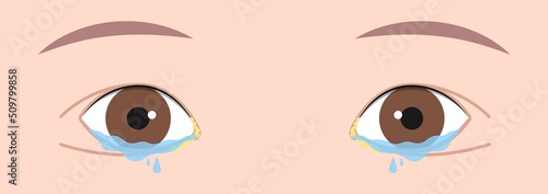 Blocked tear duct eye sinus toddler red dry swollen nasal nose pain eyelid Gland medial system drain sac birth baby child obstruct tumor polyps pink Mucus Eyedrop glaucoma Dacryolith disease