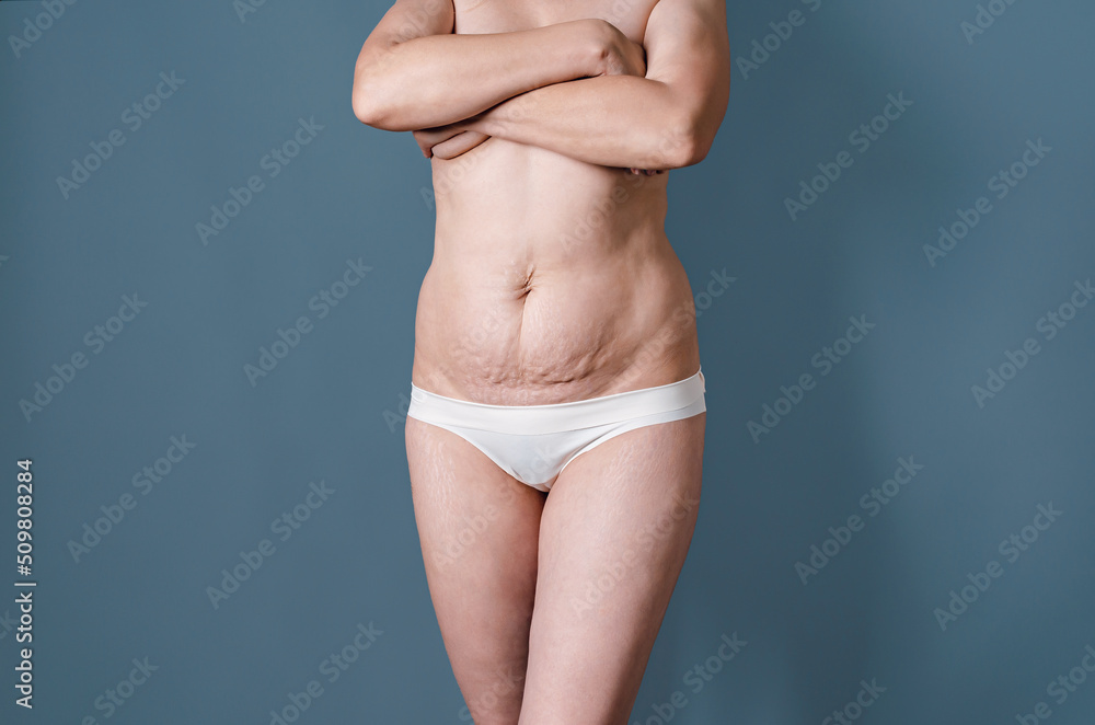 Naked female body in white lingerie after childbirth. Stretch marks on women's skin. Naked female breasts covered with hands.