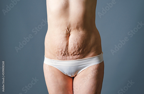 Front view of the skin of a woman with stretch marks and flabby skin after childbirth. Naked belly and thighs of a woman. Skin and body care. © romankrykh