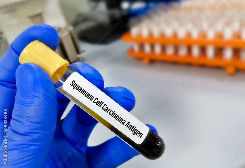 Squamous cell carcinoma antigen or SCCA testing for the diagnosis of