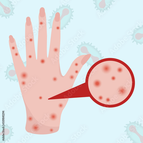 Smallpox virus. Vector illustration of smallpox virus. Monkeypox.