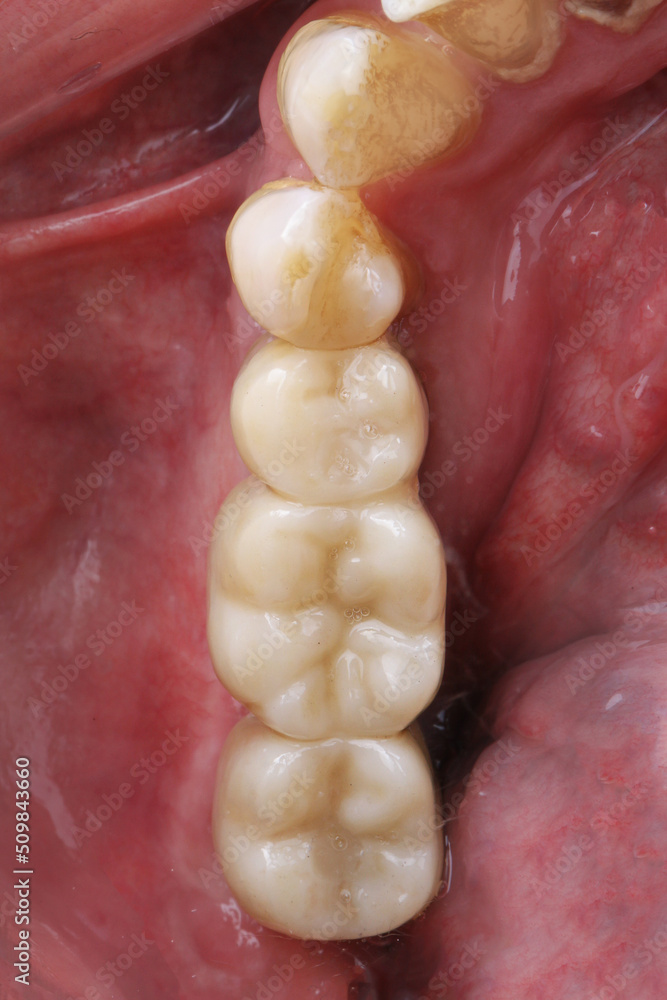 Stockfoto zirconium dental bridge for three chewing teeth installed in the gum cavity with