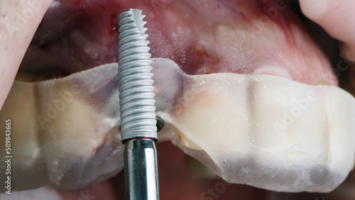 Фотография dental implant and surgical guide for high precision implantation