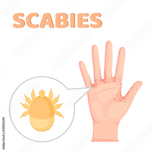 Sarcoptes scabiei. scabies. Sexually transmitted disease. Infographics. illustration on isolated background. photo