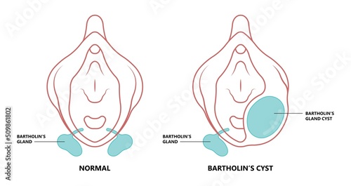 ฺฺBartholin’s cyst of vagina pain lump  mass with E. coli bacteria sex safe pelvic exam cervix swollen pus lips vulva blockage photo