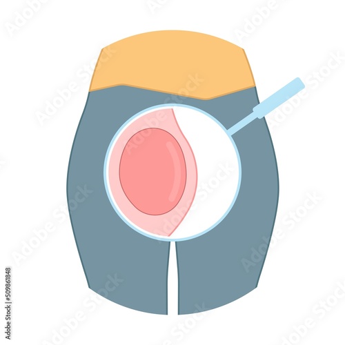 ฺฺBartholin’s cyst of vagina pain lump  mass with E. coli bacteria sex safe pelvic exam cervix swollen pus lips vulva blockage