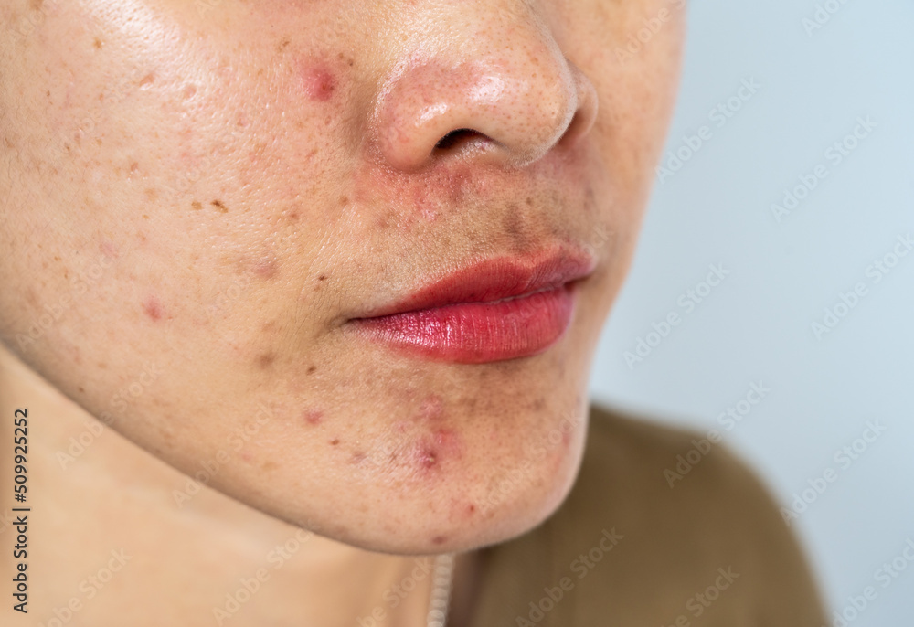 Cropped shot of woman having problems of acne inflamed on her face. Cropped shot of woman having problems of acne inflamed on her face.