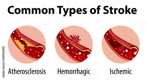 Infographic of common types of stroke