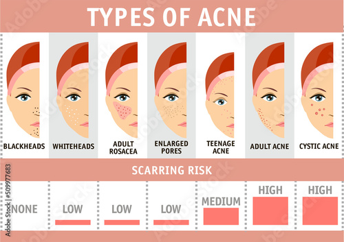 Types of acne infographics. Vector illustration types of acne, pimples, skin pores, blackhead, whitehead, scar, comedones. Isolated on white background. Girl with acne. Beauty skin care concept