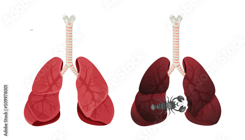 Illustration of lung smoker, lung cancer disease. The concept of stop smoking. Vector illustration.