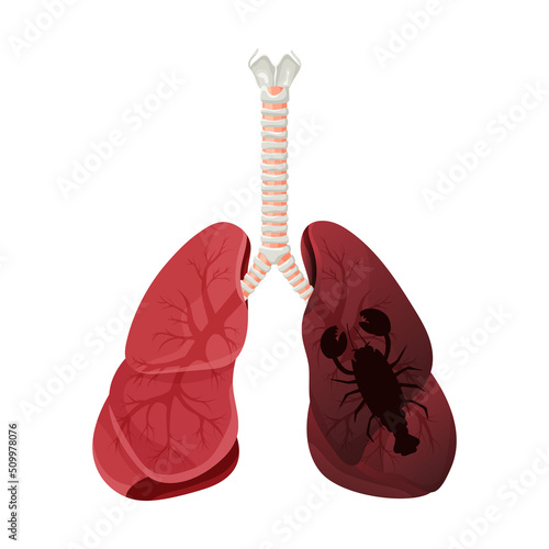 Illustration of lung smoker, lung cancer disease. The concept of stop smoking. Vector illustration.