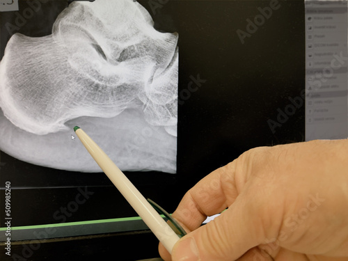 Doctor orthopedist on a computer shows a heel spur on an x-ray of the foot