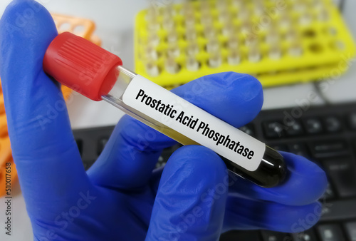 Blood sample for prostatic acid phosphatase (PAP) test in laboratory for prostate cancer diagnosis.