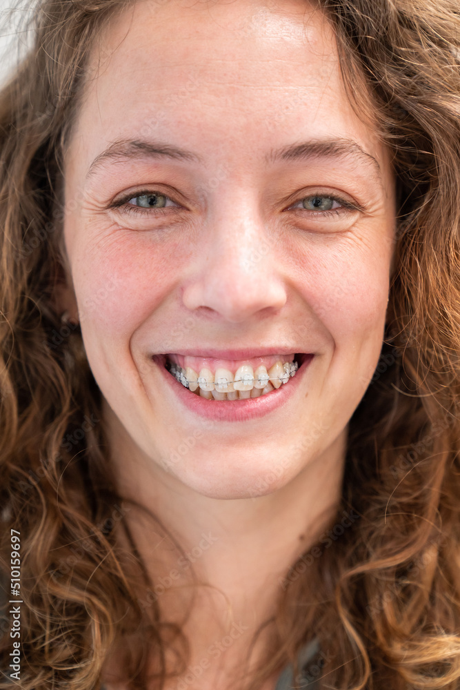 Woman With Ceramic Braces Woman With Ceramic Braces