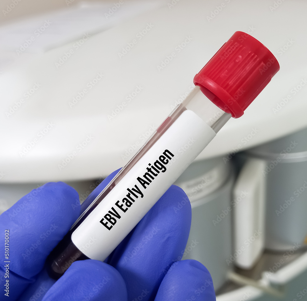 Scientist hold blood sample for EBV (EpsteinBarr virus) Early Antigen