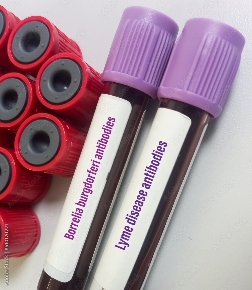 Blood sample for Borrelia burgdorferi antibody test, Lyme disease