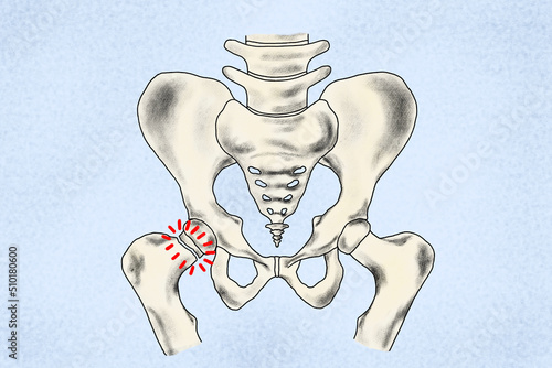 illustration of a broken femur neck or broken hip