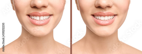 Photo Collage with photos of woman with diastema between upper front teeth before and after treatment on white background, closeup