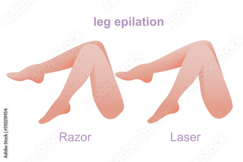 legs epilation, number of procedures, hair removal, women's legs, stages of laser hair removal of legs completely, smooth skin