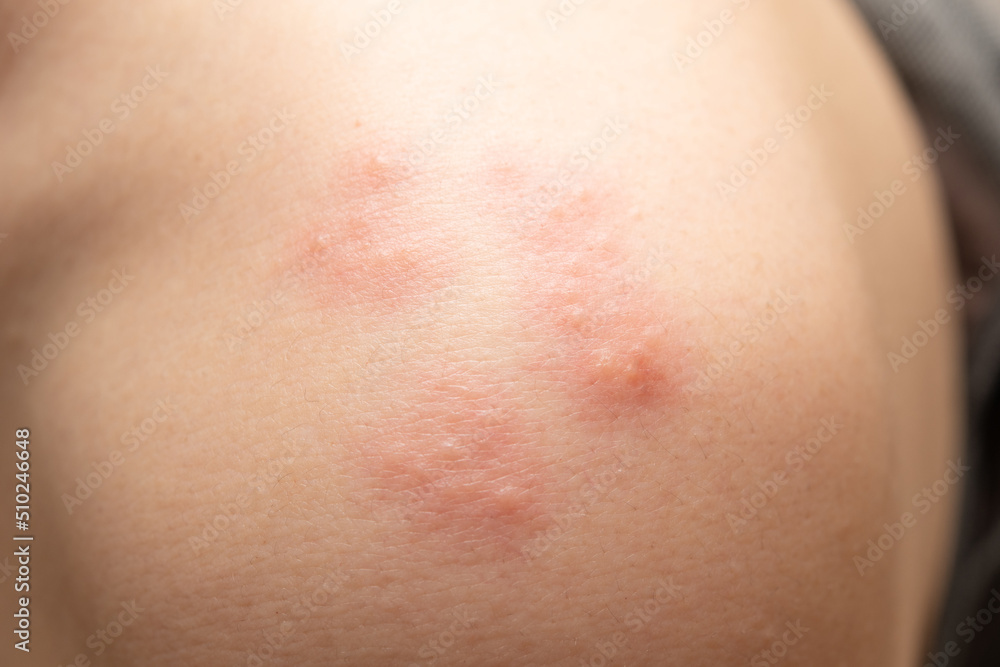 毛虫に刺されて炎症を起こした肌 毛虫に刺されて炎症を起こした肌