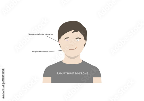 Vector illustration of man with Ramsay Hunt syndrome. A disorder characterized by paralysis of facial nerve and vesicular rash affecting ear or mouth.