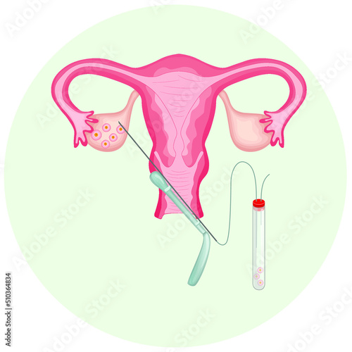 Obtaining mature eggs from the ovaries for subsequent fertilization and obtaining eggs. Puncture of follicles. Oocyte extraction